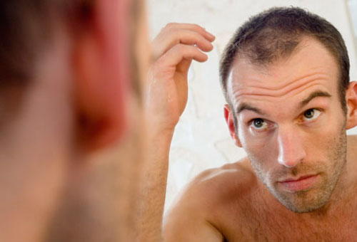 Calvitie : quelle technique de greffe de cheveux choisir ?